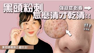 清粉刺怎麼清才乾淨？美容師教你去黑頭清除粉刺｜正確清除毛孔 [upl. by Arayk685]