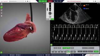 Echocardiographic Assessment of LV Diastolic Function Webinar [upl. by Nettie143]