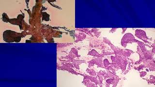 Thyroid Cytology II Cases [upl. by Llerroj830]