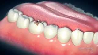 Dental Crowns Everything You Need to Know [upl. by Batista797]