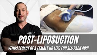 Post Liposuction  Venus Legacy RF  Female HD Lipo  Six Pack  West Hollywood CA  Dr Jason Emer [upl. by Niamrej]