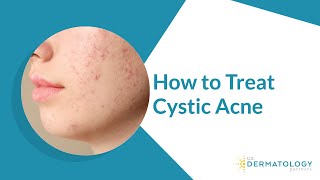 How to Treat Cystic Acne [upl. by Goggin]