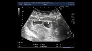 Ultrasound Video showing Early first trimester  6 weeks 01 day  twin Pregnancy [upl. by Emory]