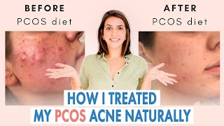 How I Healed My Cystic Acne NATURALLY PCOS amp Hormonal Acne [upl. by Kciderf86]