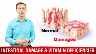 Intestinal Obstruction amp Vitamin Deficiencies – Dr Berg [upl. by Milford]