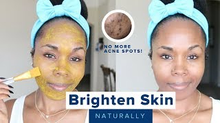 How to Brighten Skin Reduce Acne Scars Hyperpigmentation amp Discoloration  Home Remedies [upl. by Noiramed]