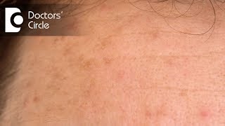 What is Hyperpigmentation and how to treat it  Dr Jyoti Jha [upl. by Chapland310]