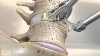 Vertibroplasty amp Kyphoplasty Vertebral Compression Fracture Treatment  DePuy Videos [upl. by Anwahsak630]