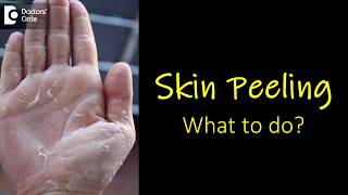 What causes skin peeling from fingers and feet How to manage  Dr Rasya Dixit [upl. by Nywg]