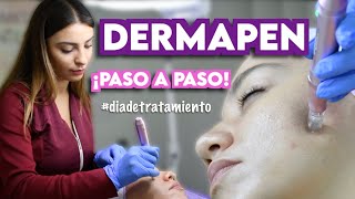 DERMAPEN  TRATAMIENTO DE MICRONEEDLING  Ximena Ramaya [upl. by Ahsea806]