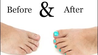 Toenail Treatment  Miracle Gelous Reconstruction [upl. by Ahsiet86]