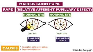 Abnormal Pupillary Reflexes  Ophthalmology [upl. by Ymerej975]