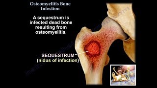 Osteomyelitis Bone Infection  Everything You Need To Know  Dr Nabil Ebraheim [upl. by Annuhsal422]