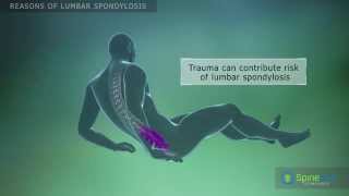 Lumbar Spondylosis Reasons [upl. by Elodie]