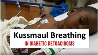 Kussmaul Breathing in Diabetic Ketoacidosis [upl. by Varrian]