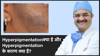 What Is Hyperpigmentation And Causes Of Hyperpigmentation Part 1  ClearSkin Pune  In HINDI [upl. by Ducan939]