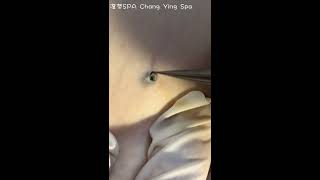 深層黑頭 Deep DPOW extraction  澄熒SPA [upl. by Constance]